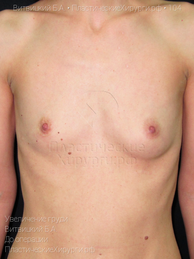 увеличение груди, пластический хирург Витвицкий Б. А., результат №104, ракурс 1, фото до операции