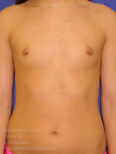 увеличение груди, пластический хирург Кузин Д. А., результат №372, ракурс 1, фото до операции