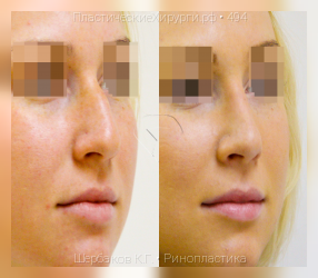 ринопластика, результат №494, предварительное изображение до и после операции