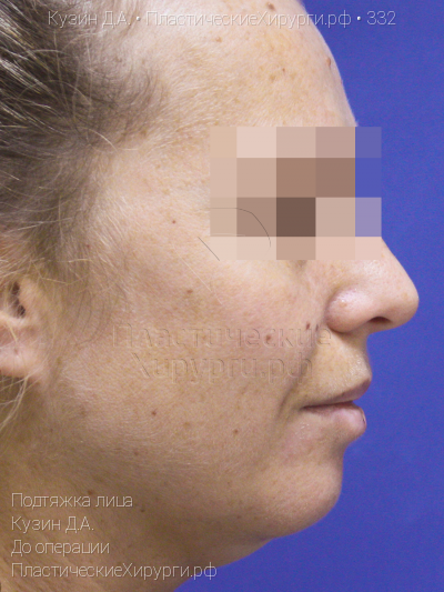 подтяжка лица, пластический хирург Кузин Д. А., результат №332, ракурс 3, фото до операции