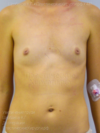 увеличение груди, пластический хирург Щербаков К. Г., результат №441, ракурс 1, фото до операции