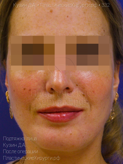 подтяжка лица, пластический хирург Кузин Д. А., результат №332, ракурс 1, фото после операции