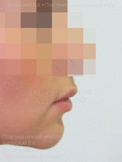 пластика нижней челюсти, пластический хирург Витвицкий Б. А., результат №114, ракурс 3, фото после операции