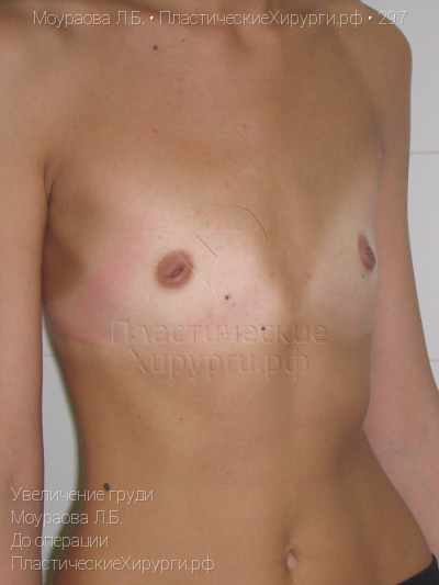 увеличение груди, пластический хирург Моураова Л. Б., результат №297, ракурс 2, фото до операции