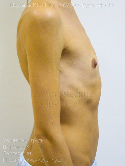 увеличение груди, пластический хирург Щербаков К. Г., результат №444, ракурс 3, фото до операции