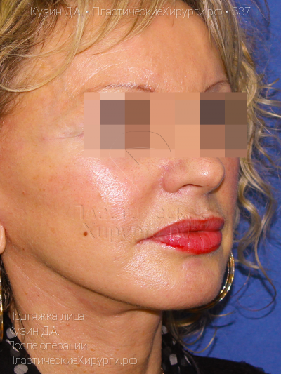 подтяжка лица, пластический хирург Кузин Д. А., результат №337, ракурс 2, фото после операции