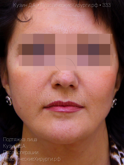 подтяжка лица, пластический хирург Кузин Д. А., результат №333, ракурс 1, фото после операции