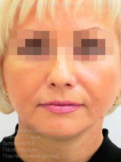 эндоскопическая подтяжка нижней трети лица, пластический хирург Витвицкий Б. А., результат №24, ракурс 1, фото после операции