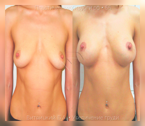 увеличение груди, результат №55, предварительное изображение до и после операции