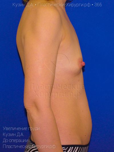увеличение груди, пластический хирург Кузин Д. А., результат №366, ракурс 3, фото до операции