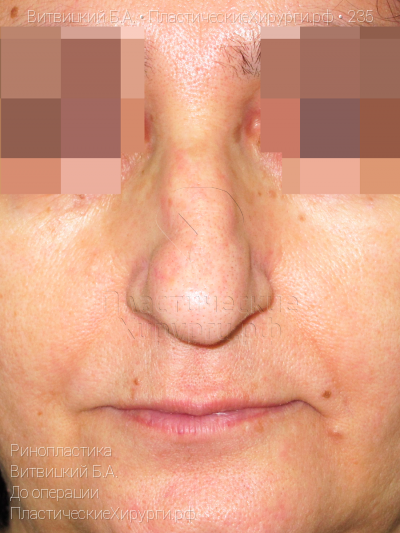 ринопластика, пластический хирург Витвицкий Б. А., результат №235, ракурс 1, фото до операции