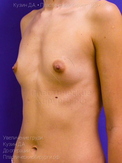 увеличение груди, пластический хирург Кузин Д. А., результат №368, ракурс 2, фото до операции