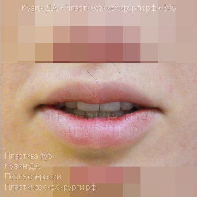 пластика губ, пластический хирург Кузин Д. А., результат №345, ракурс 2, фото после операции