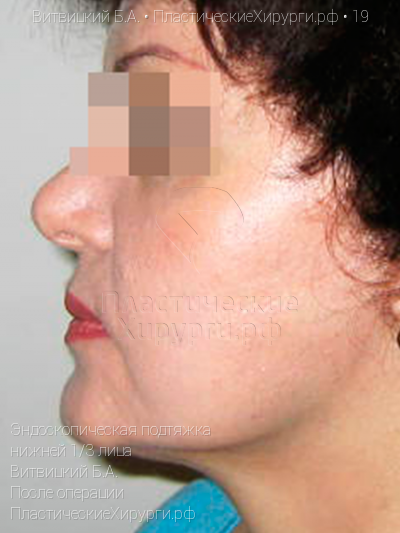 эндоскопическая подтяжка нижней трети лица, пластический хирург Витвицкий Б. А., результат №19, ракурс 2, фото после операции