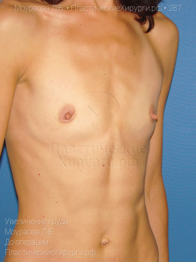 увеличение груди, пластический хирург Моураова Л. Б., результат №287, ракурс 2, фото до операции