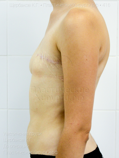 увеличение груди, пластический хирург Щербаков К. Г., результат №416, ракурс 5, фото до операции