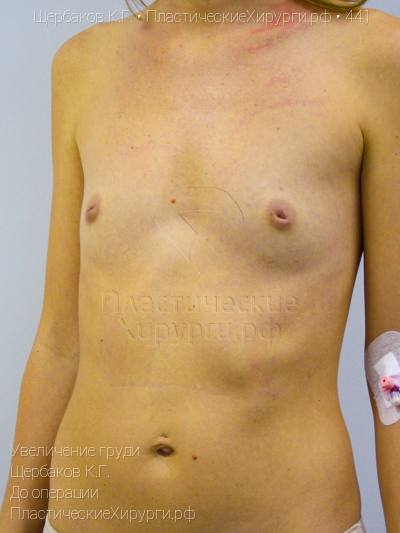 увеличение груди, пластический хирург Щербаков К. Г., результат №441, ракурс 4, фото до операции