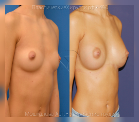 увеличение груди, результат №498, предварительное изображение до и после операции