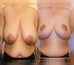 подтяжка груди, результат №378, предварительное изображение до и после операции