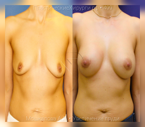 увеличение груди, результат №499, предварительное изображение до и после операции