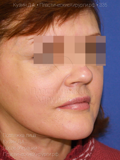 подтяжка лица, пластический хирург Кузин Д. А., результат №335, ракурс 2, фото после операции