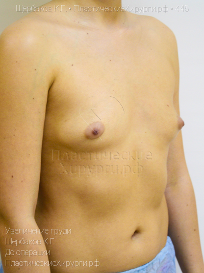 увеличение груди, пластический хирург Щербаков К. Г., результат №445, ракурс 2, фото до операции