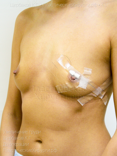 увеличение груди, пластический хирург Щербаков К. Г., результат №431, ракурс 4, фото до операции